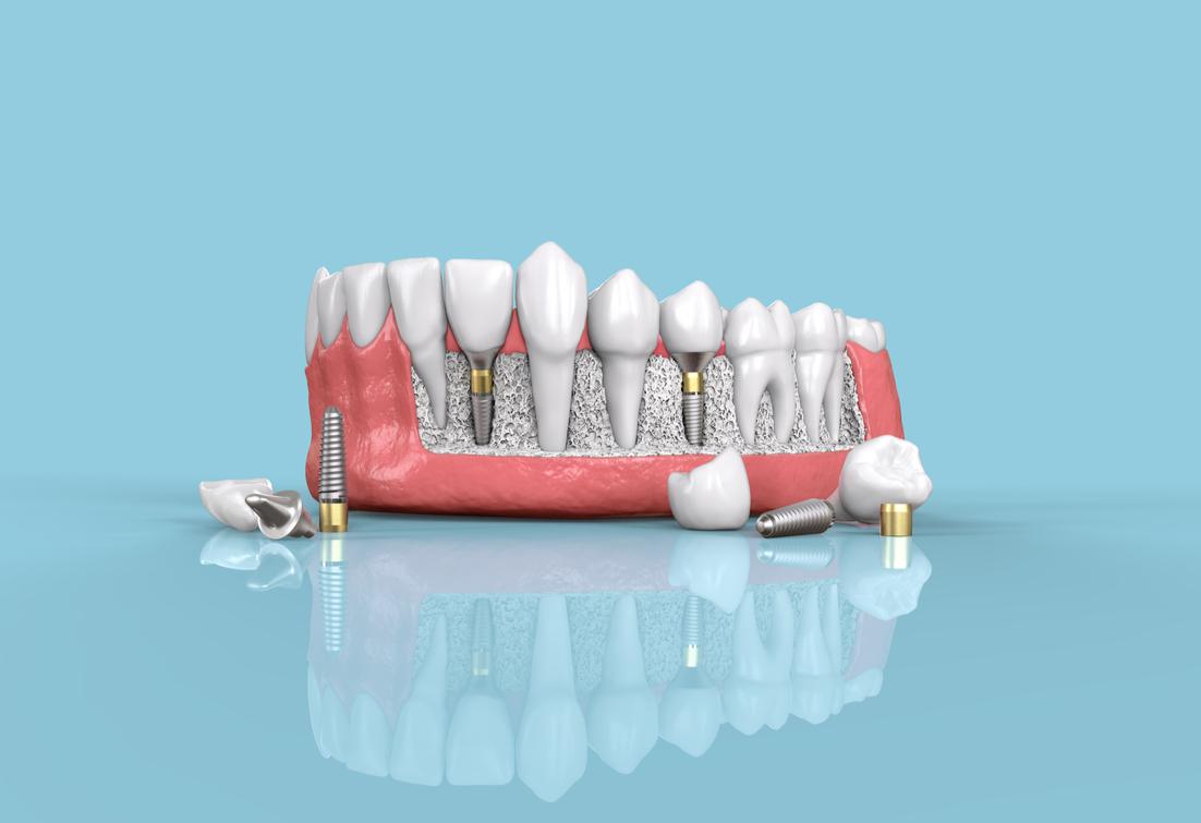 Dental Implants in Fort Worth, TX